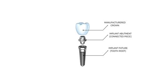 Dentalopolis-Dental Implant Anatomy - Dentalopolis