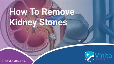 How to Remove Kidney Stones | 100% Best Treatment Care