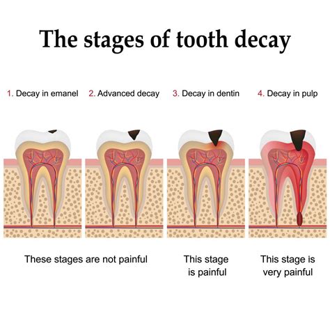 Dental Cavities & Tooth Fillings | Oak Street Dental - Victoria, BC