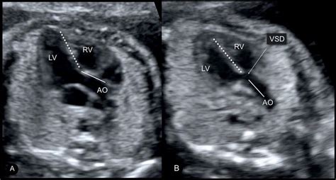 Pin on ultrasound images