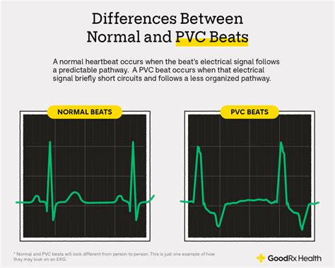 Premature Ventricular Contractions Ecg