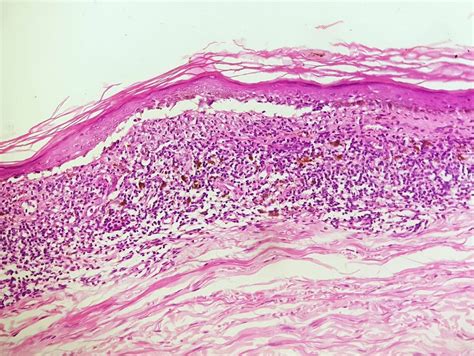 Oral Lichen Planus Histology