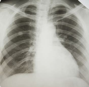 All about mesothelioma