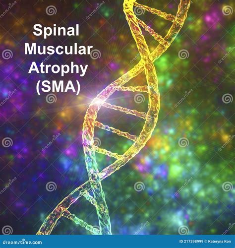 Spinal Muscular Atrophy, SMA, a Genetic Neuromuscular Disorder Stock ...