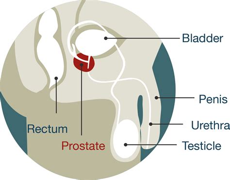 Prostate cancer | Ministry of Health NZ