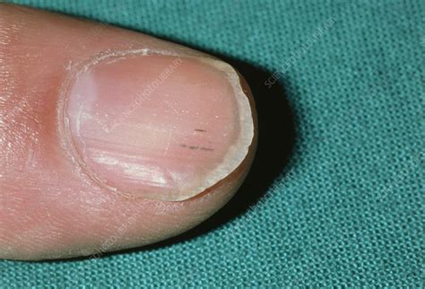 Splinter haemorrhage on fingernail in endocarditis - Stock Image - M172/0281 - Science Photo Library