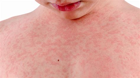 Rash on Chest Pictures, Causes, Symptoms, Remedies and Treatment ...