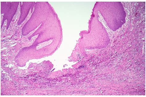 Epulis Fissuratum Histology