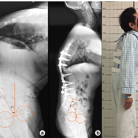 Positioning of a patient with ankylosing spondylitis on the surgical ...