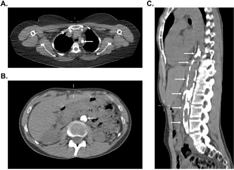 Figure 3 from Vascular calcification in patients with large-vessel ...