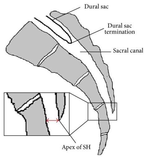 Caudal Anesthesia in Children - OpenAnesthesia