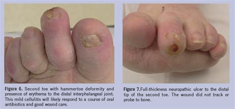 Diabetic Foot Ulcer