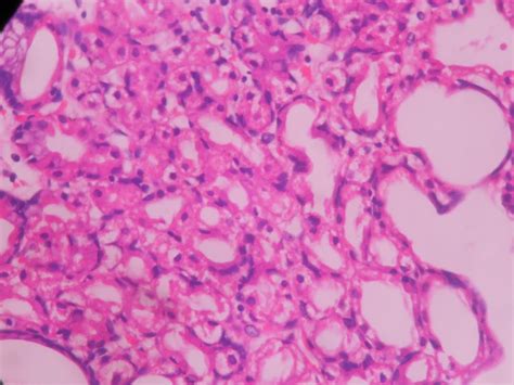 Fundic gland polyp – Histopathology.guru