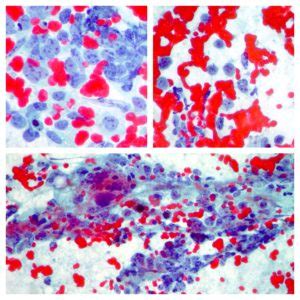 Cytopathology of lymph nodes-FNAC – Cellnetpathology.com