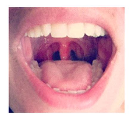 Swollen (Enlarged) Uvula – Causes, Symptoms, Treatment, Home Remedies