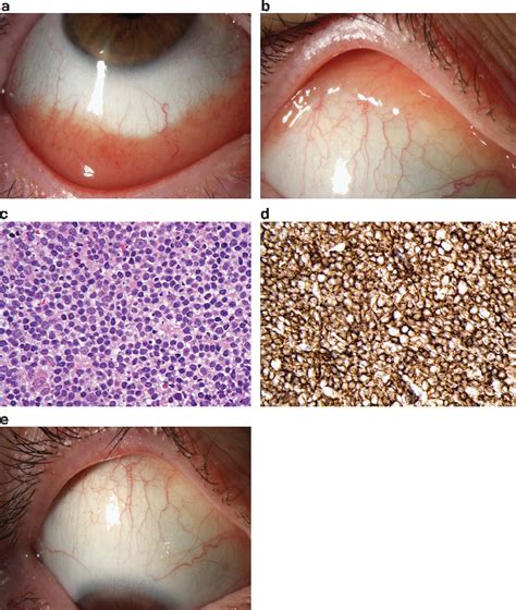 (a) Digital photograph of the right inferior conjunctival lesion at ...