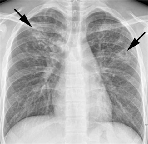 Pulmonary TB | Medical imaging, Medical radiography, Radiology