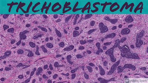 Trichoblastoma Histology