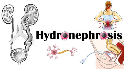 Hydronephrosis - Definition, Functional Anatomy, Causes, Signs & Symptoms, Diagnosis & Treatment ...