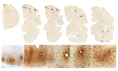 Aaron Hernandez Had CTE, BU Researchers Say | WBUR News