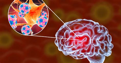 CNS Infections - Mind The Bleep