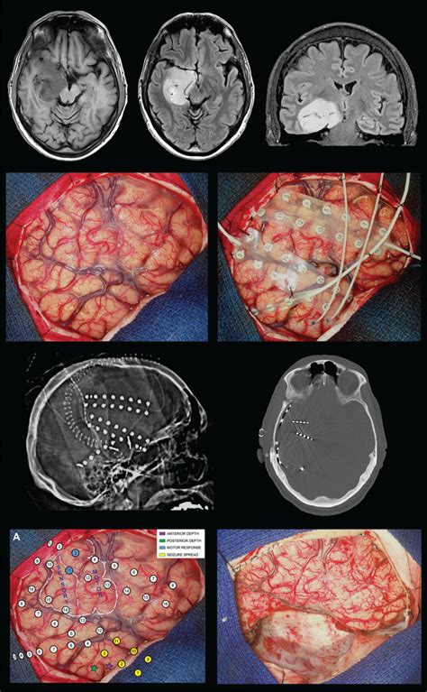 Pathogenesis and Management of Brain Tumor-Related Epilepsy - Gliomas - NCBI Bookshelf