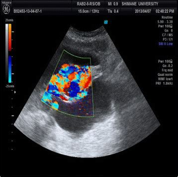 Color flow Doppler ultrasound shows a mosaic pattern of blood flow ...