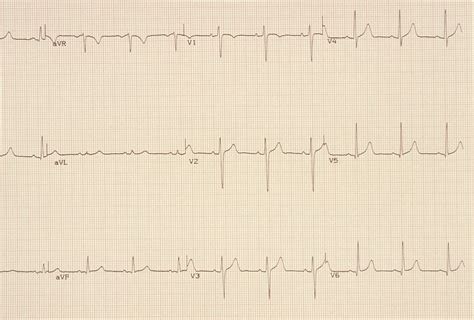 Electrocardiogram (ECG or EKG): Procedure and Results