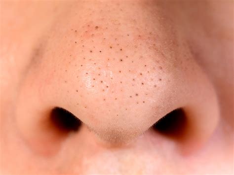 Nose Blackheads: 15 Best Ways to Remove Black Clogged Pores on Nose