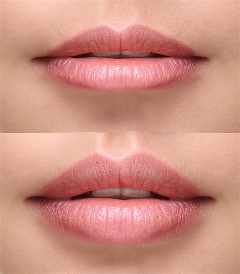 Pin by Sarah Alexis on Estheticians | Botox lips, Lip fillers, Lip injections