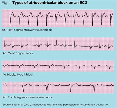 Ekg Strips Sinus Rhythm Normal Sinus Rhythm Sinus Bradycardia Sinus | Hot Sex Picture