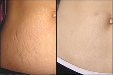 Stretch Marks (Striae) Treatment | Beauty and Laser Clinic