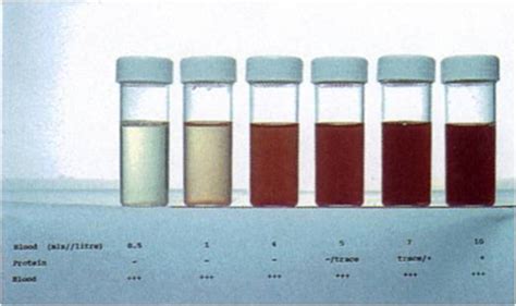 BLOOD IN URINE (HEMATURIA) | HubPages