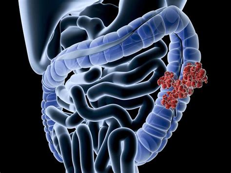 Types and Location of Colon Cancer