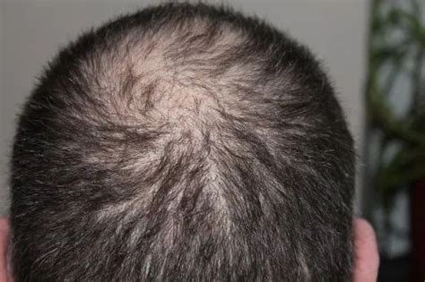 Scabs and Sores on the Scalp: What are the Causes? - fitness and health advisor