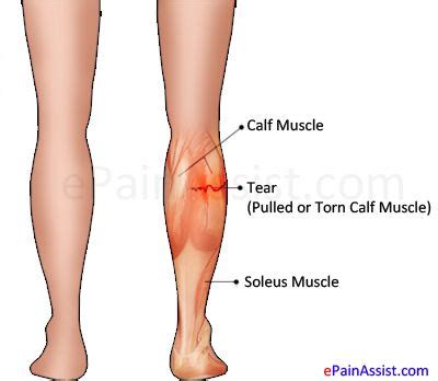 Exercises For Torn Calf Muscles - Dumbbell Shub