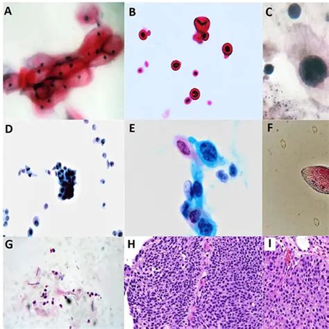 Malignant Cells Cytology, Urine | Test Price In Delhi, India | Ganesh Diagnostic