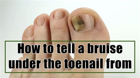 Bruised Toenail Green - Nail Ftempo