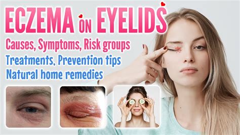 Eczema on Eyelids Causes, Symptoms, Risk factors, Treatment, Prevention ...