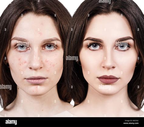 Girl with acne before and after treatment Stock Photo - Alamy