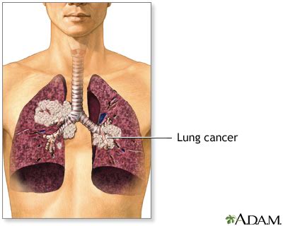 Lung cancer - small cell Information | Mount Sinai - New York