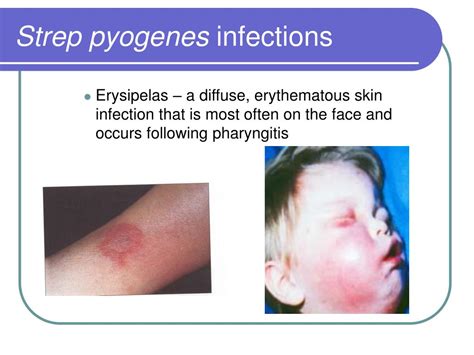 Streptococcus Pyogenes Symptoms