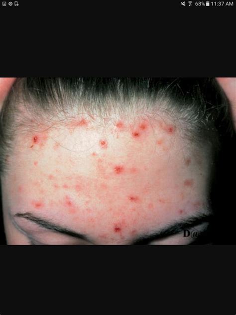 Acne excoriee | Acne excoriee, Skin disorders, Acne