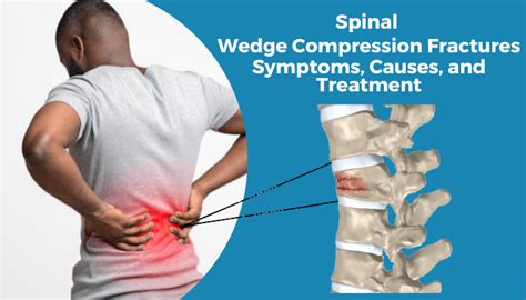 Compression Fracture Lumbar