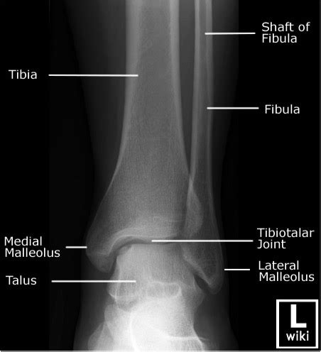 Adult Ankle Radiographs - Trauma - Orthobullets