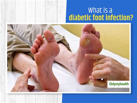 Diabetic Foot Infection: Symptoms, Risk Factors, Treatment And Self ...