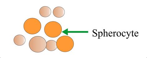 Red Blood Cell (RBC):- Part 5 - RBC Morphology Differential Diagnosis, and Interpretations ...