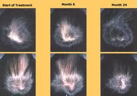 Propecia Before and After Photos, Hair Loss Propecia – Man-Health-Magazine-Online.com