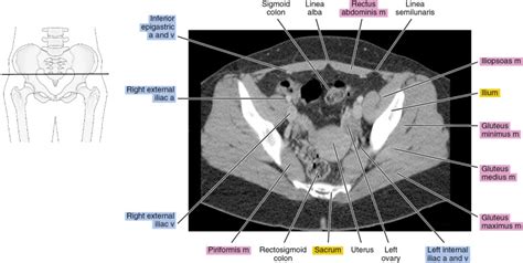 CT of the female pelvis | Radiology Key