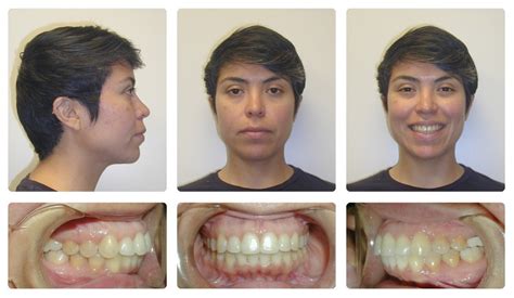 Orthodontic Before and After Photos | Brodsky Orthodontics